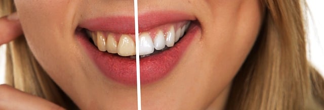 zuby před a po bělení